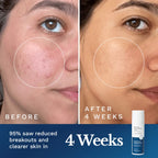 Clear Out Skin Clarifying Cream
