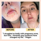 The Acne-Prone Bundle